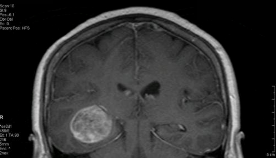 Tumore Al Cervello C Un Sintomo Banalissimo A Cui Nessuno D