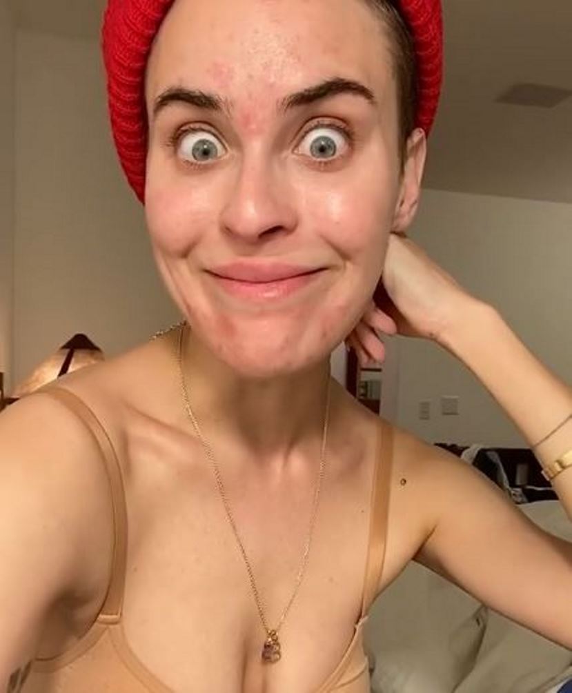 Tallulah Willis Al Naturale Mostra Con Orgoglio Brufoli E Imperfezioni