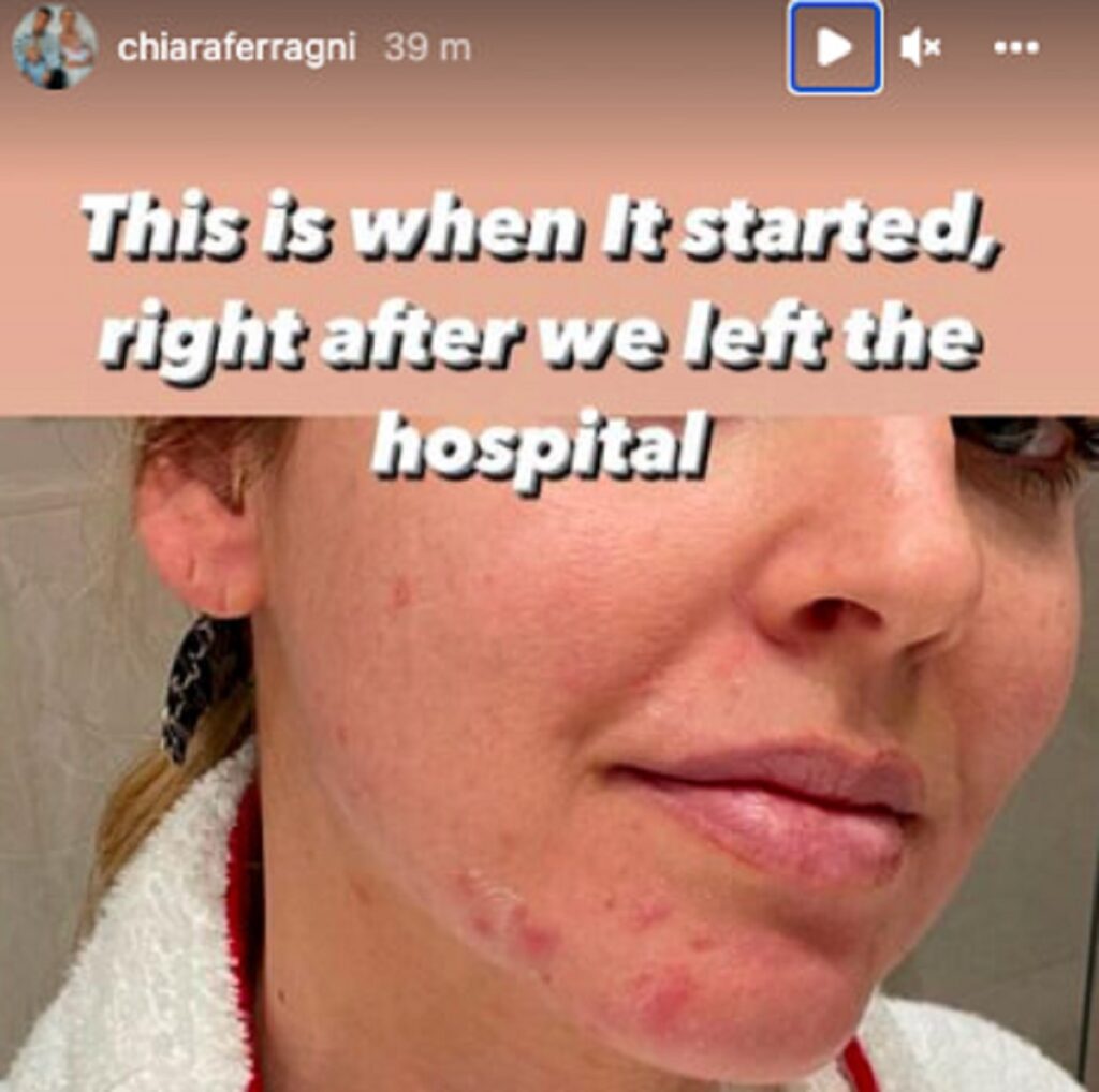 Chiara Ferragni sfogo viso stress messaggio