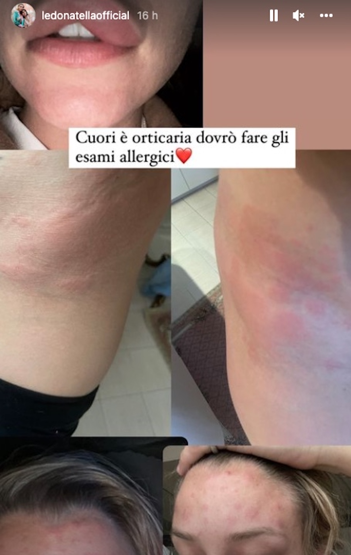 Giulia Provvedi orticaria