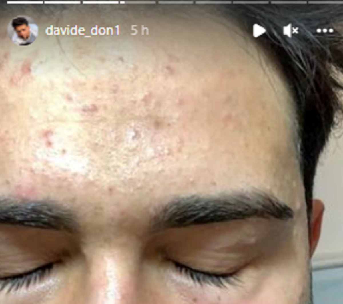 Davide Donadei viso rovinato problema salute acne ex tronista UeD