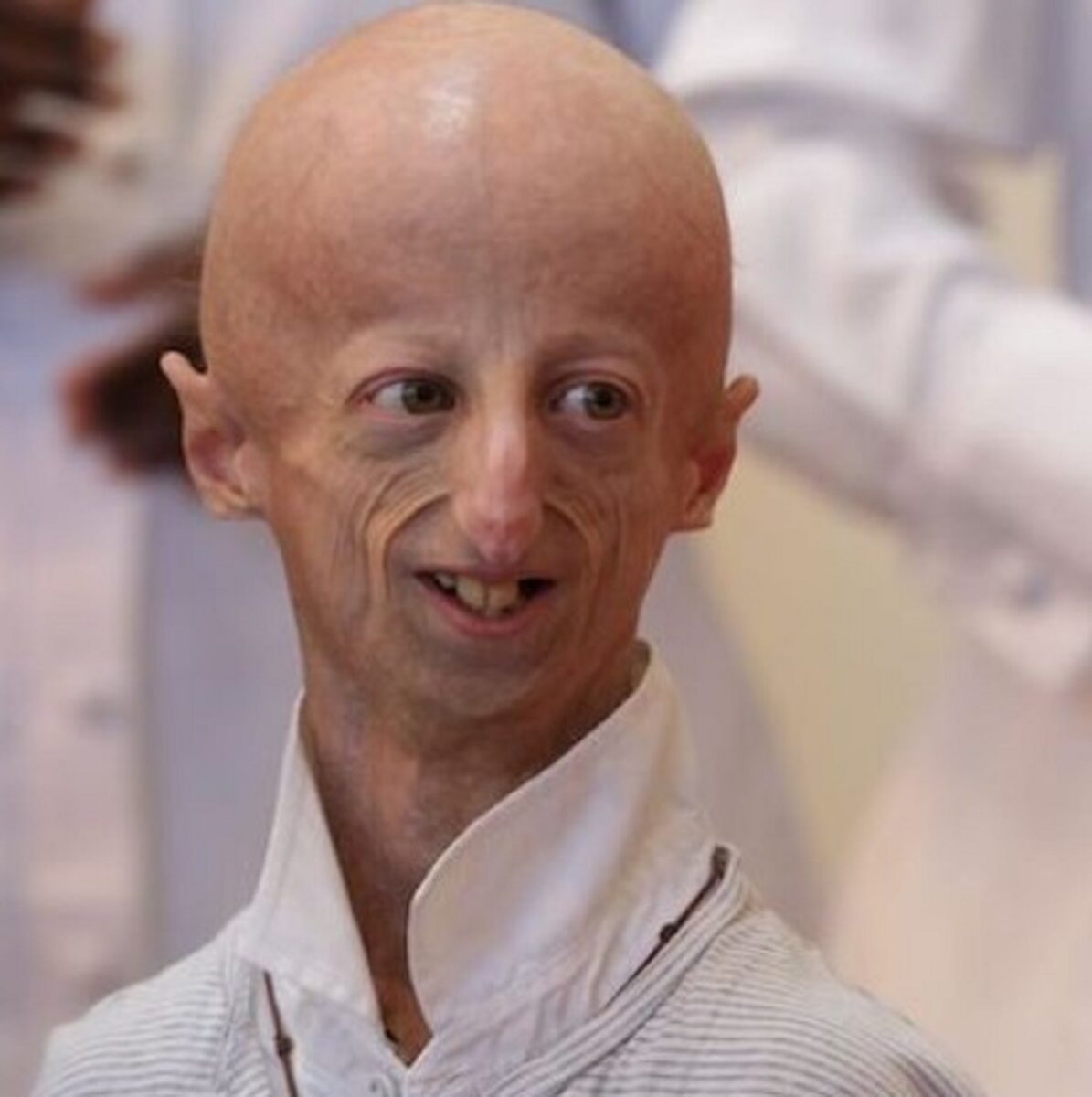 morto Sammy Basso, era affetto da progeria 