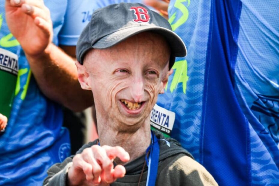 morto Sammy Basso, era affetto da progeria