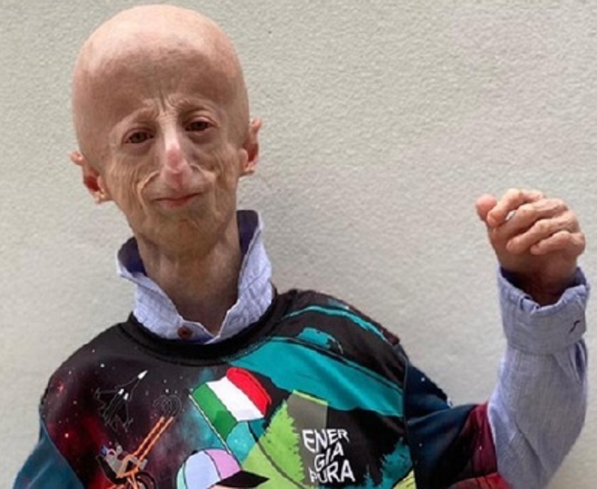 morto Sammy Basso, era affetto da progeria 