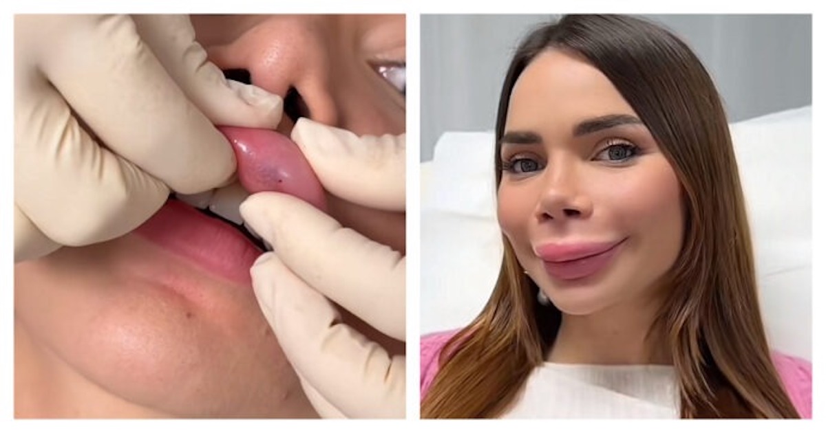 L’influencer Nicole Pallado si sottopone alla ialuronidasi